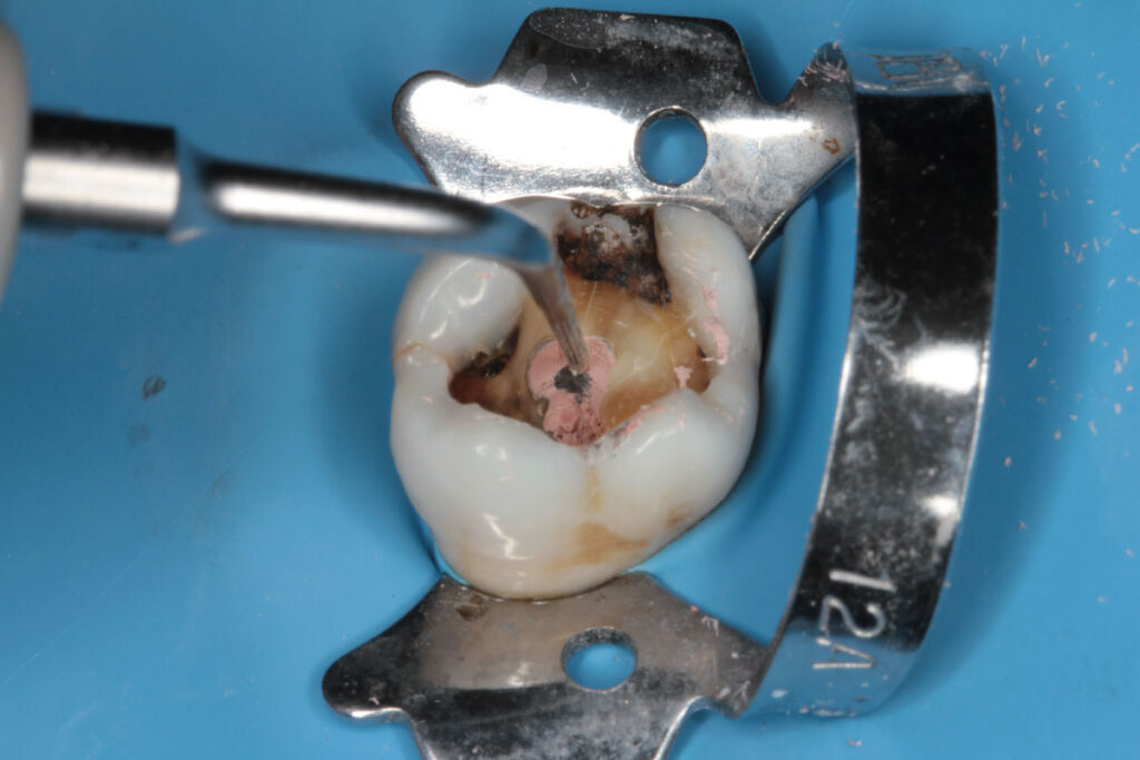 Retratamiento de obturadores con vástago de